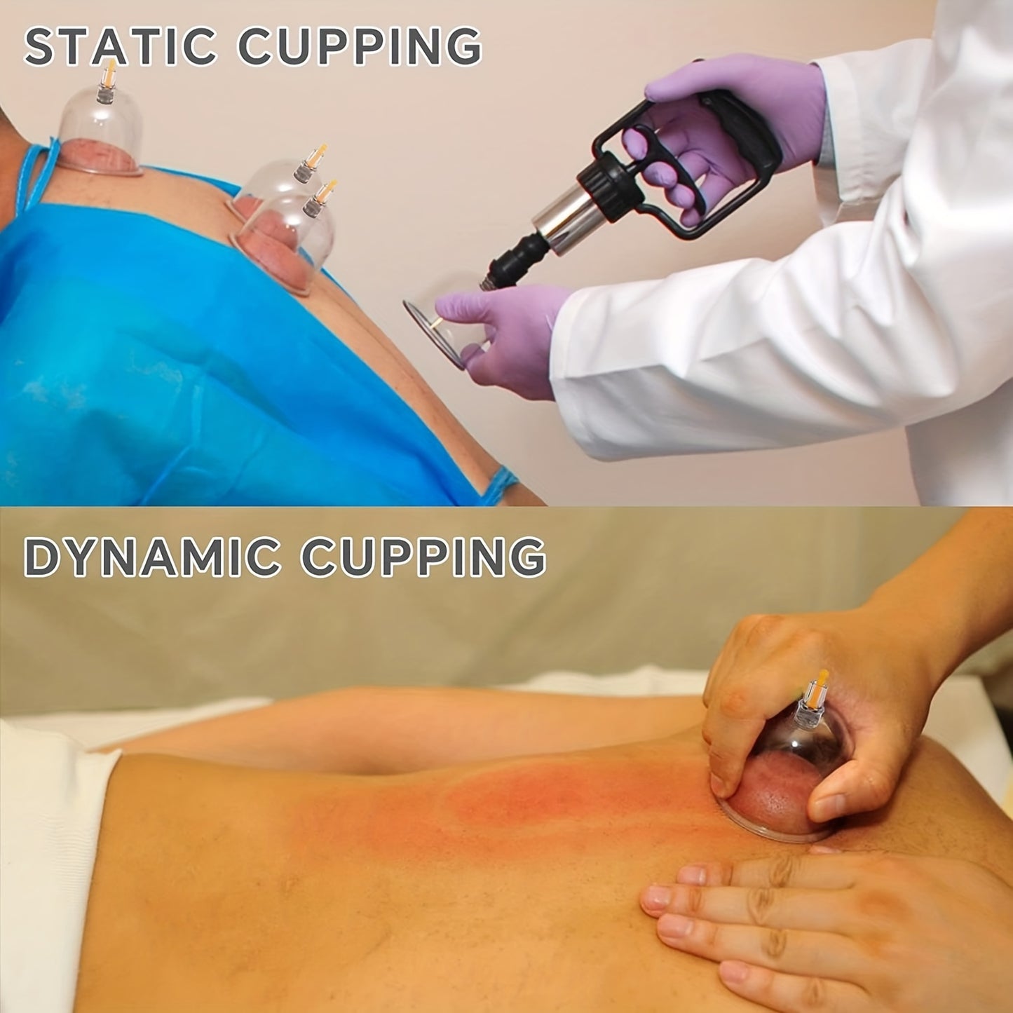 Professional Cupping Set with Pump, Vacuum Suction Cups, Home Use Cupping Kit for Massage
